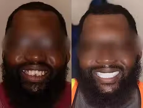 Before And After Dental Implant Smile Image