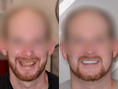 Before And After Dental Implant Smile Image