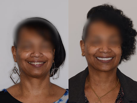 Before And After Dental Implant Smile Image