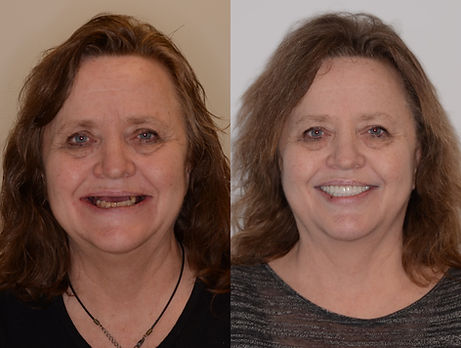 Before And After Dental Implant Smile Image