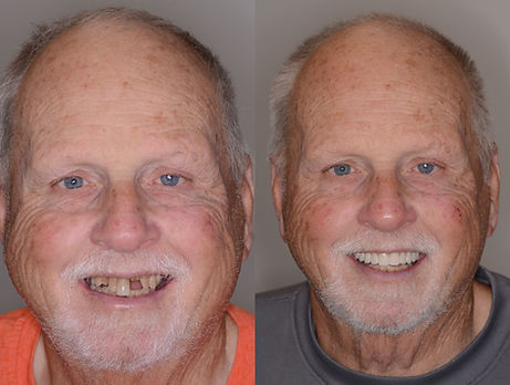 Before And After Dental Implant Smile Image