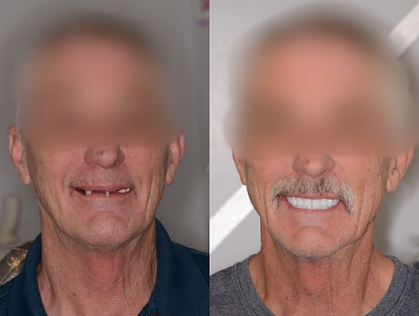 Before And After Dental Implant Smile Image