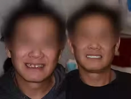 Before And After Dental Implant Smile Image