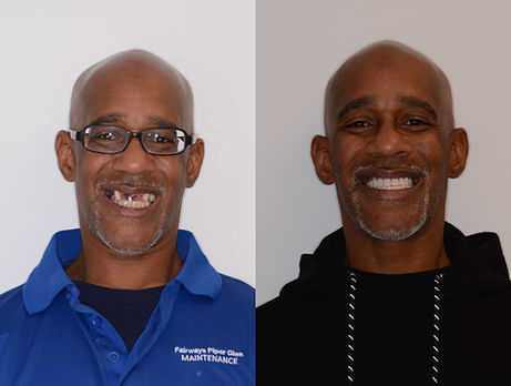 Before And After Dental Implant Smile Image