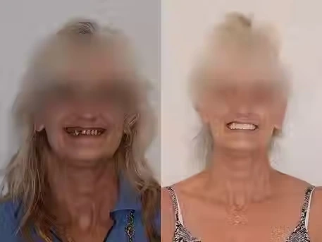 Before And After Dental Implant Smile Image