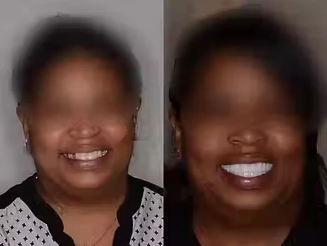 Before And After Dental Implant Smile Image