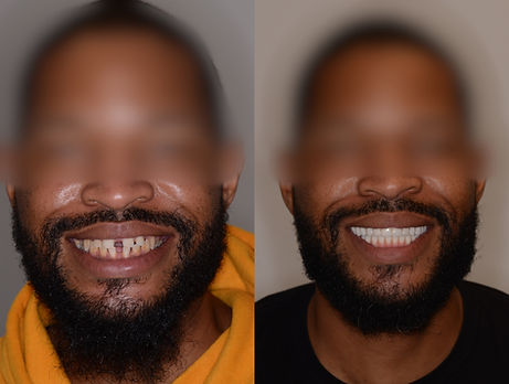 Before And After Dental Implant Smile Image