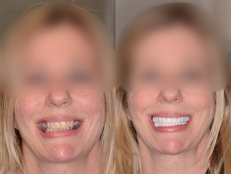 Before And After Dental Implant Smile Image