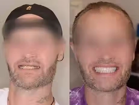 Before And After Dental Implant Smile Image