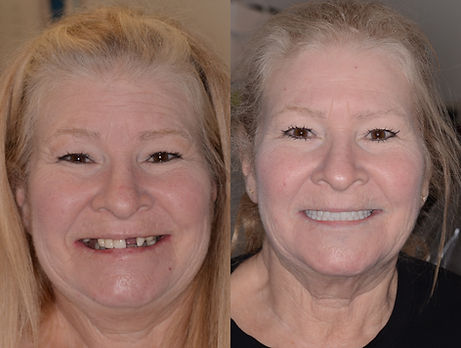 Before And After Dental Implant Smile Image