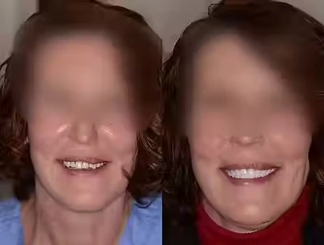 Before And After Dental Implant Smile Image