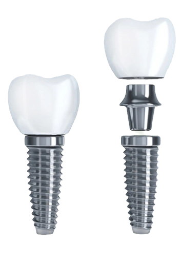 Single Implant Technology image