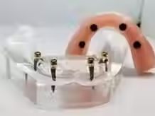 Snap In Implant Dentures