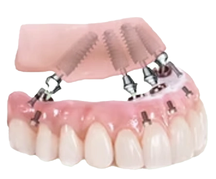 Volume 5 Dental Implants Image